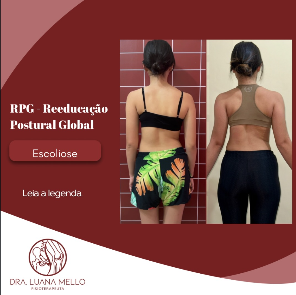 Material da Dra. Luana Mello sobre RPG e escoliose, com dois registros posturais de uma paciente.